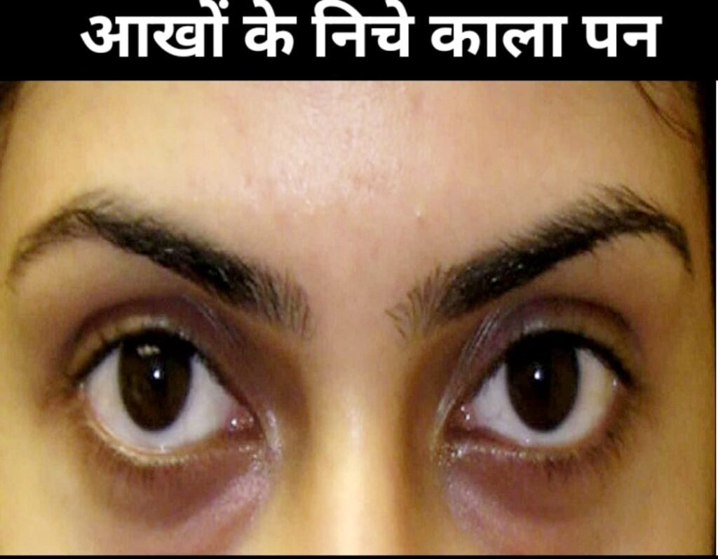 आंखों के नीचे कालापन कैसे दूर करें।How to remove blackness under the eyes.